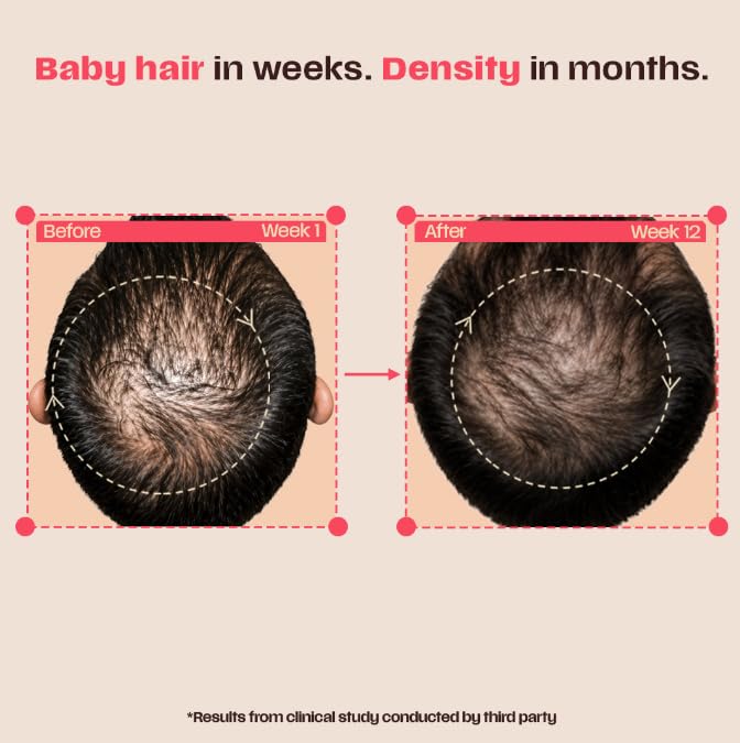 Days Ahead Leave-In Hair Growth Serum | Redensyl, Anagain, Caffeine & Ceramide | Promotes New Hair Growth | Advanced Anti Hair Fall Treatment | Non-Sticky, Oil-Control Formula |For Both Women & Men