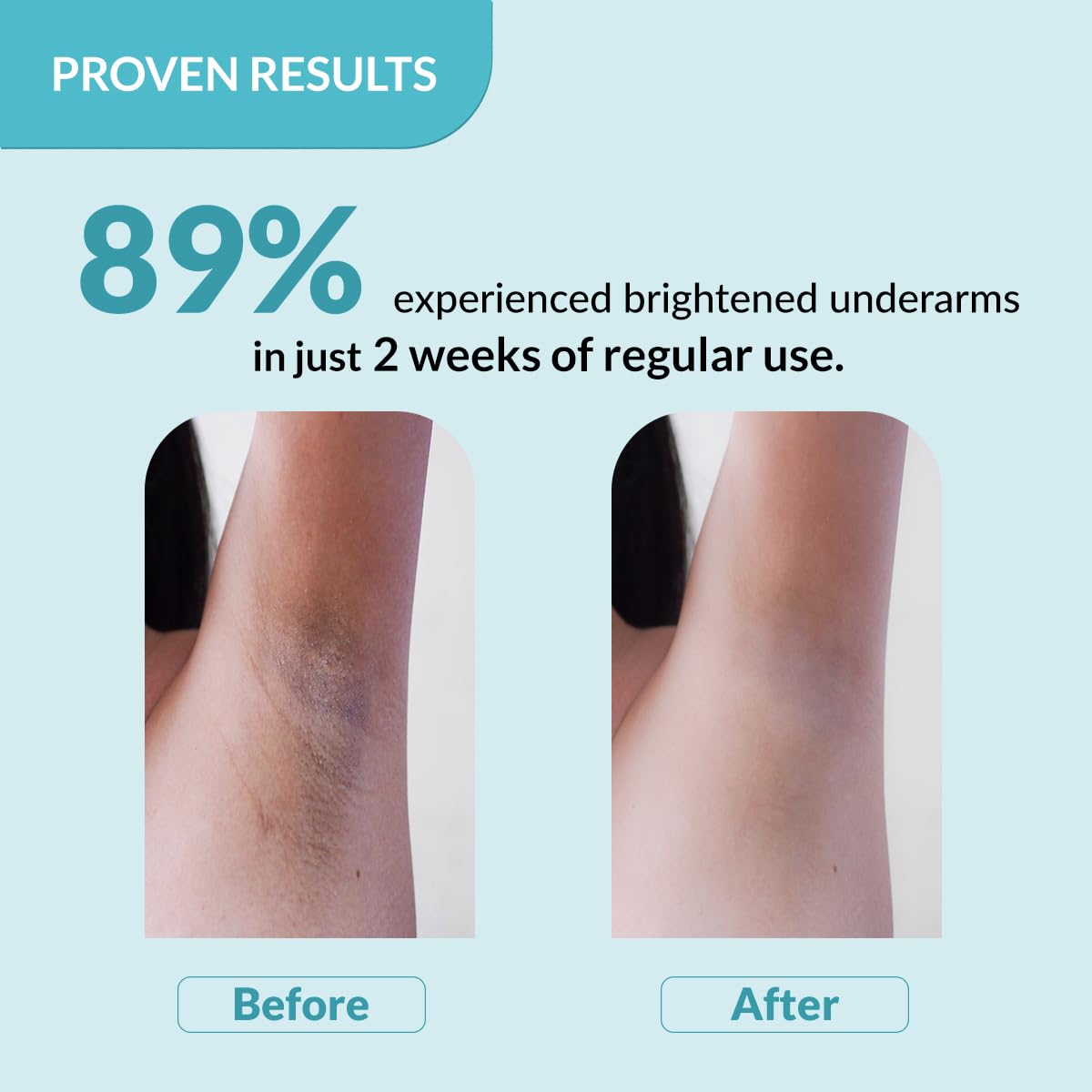 Fixderma Nigrifix Underarm Roll on with 6% AHA, Lactic Acid & 1% Mandelic Acid & Kojic Acid | Brightens Skin & Exfoliates Underarm | For All Skin Type, Men & Women - 60ml