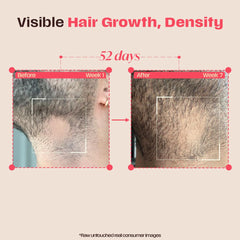 Days Ahead Leave-in Hair Growth Ampoule Serum (Roll on) | 16% Growth Actives | PDRN, Redensyl, Anagain | Hair Growth Serum | Promotes Growth, Increases Density | Non-Greasy | For Women & Men | 25 ml