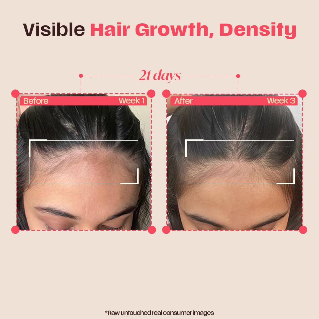 Days Ahead Leave-in Hair Growth Ampoule Serum (Roll on) | 16% Growth Actives | PDRN, Redensyl, Anagain | Hair Growth Serum | Promotes Growth, Increases Density | Non-Greasy | For Women & Men | 25 ml