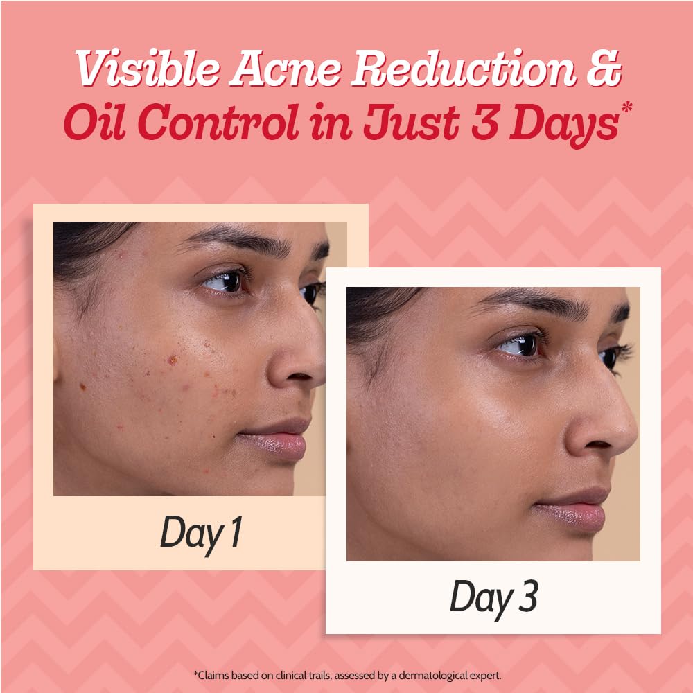Chemist At Play 2% Salicylic Acid Face Serum for Acne-Prone Skin | Treats Active Acne & Controls Oil | Fades Acne Marks | Improves Skin Texture | Lightweight, Non-Comedogenic | For Men & Women | 30 ml