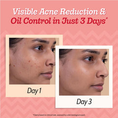 Chemist At Play 2% Salicylic Acid Face Serum for Acne-Prone Skin | Treats Active Acne & Controls Oil | Fades Acne Marks | Improves Skin Texture | Lightweight, Non-Comedogenic | For Men & Women | 30 ml