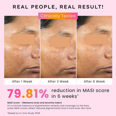 Hyphen 4% Tranexamic Acid + 5% Niacinamide Biphasic De-Pigmentation Serum | Correction & Prevents Hyperpigmentation, Dark Spots & Melasma| In-vivo tested & Non-Comedogenic| Deep Penetration - 30 ml