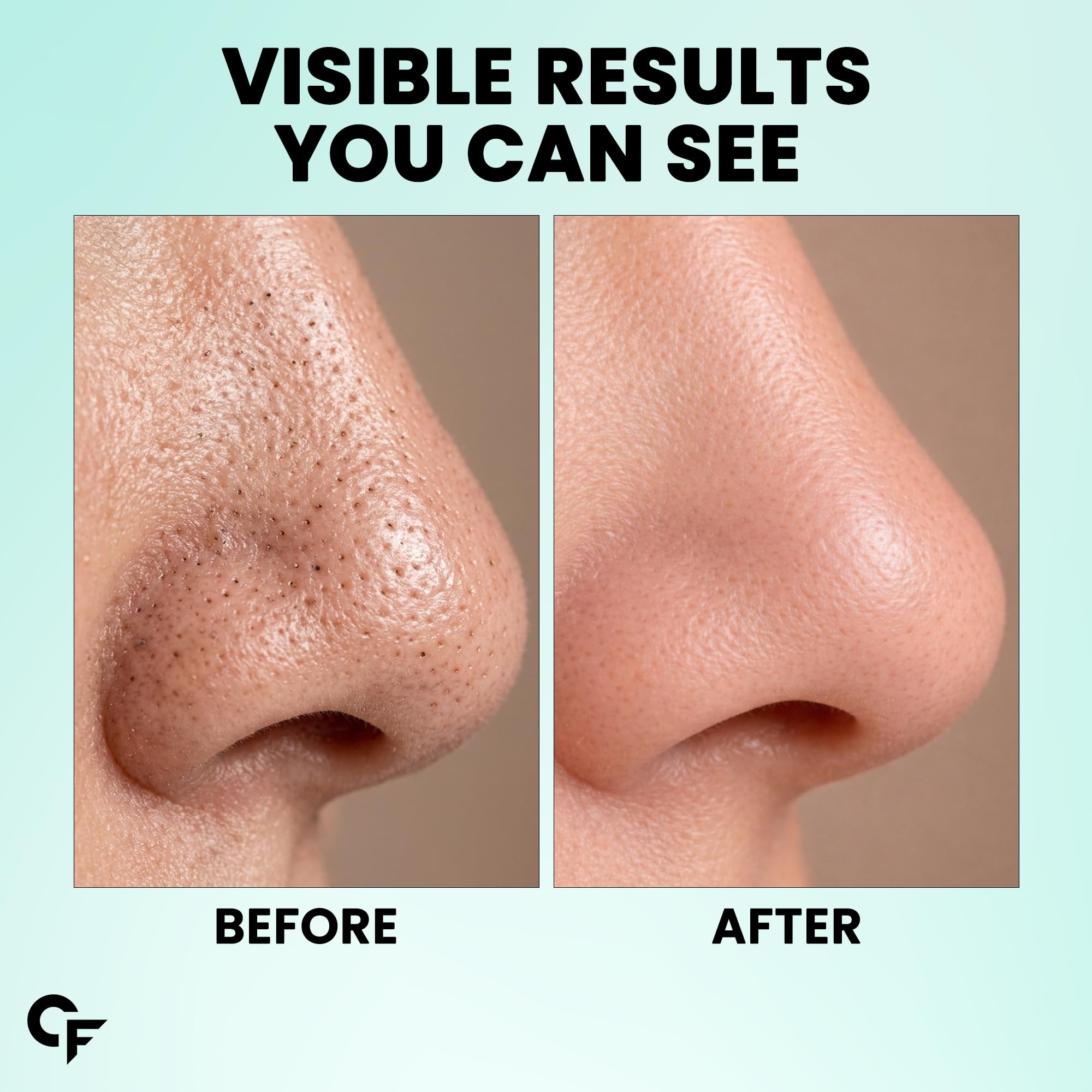 Carbamide Forte Charcoal Nose Strips for Blackhead Removal | Blackheads Removal Strips for painless and instant black head removal | Works within 15 minutes - 10 Strips