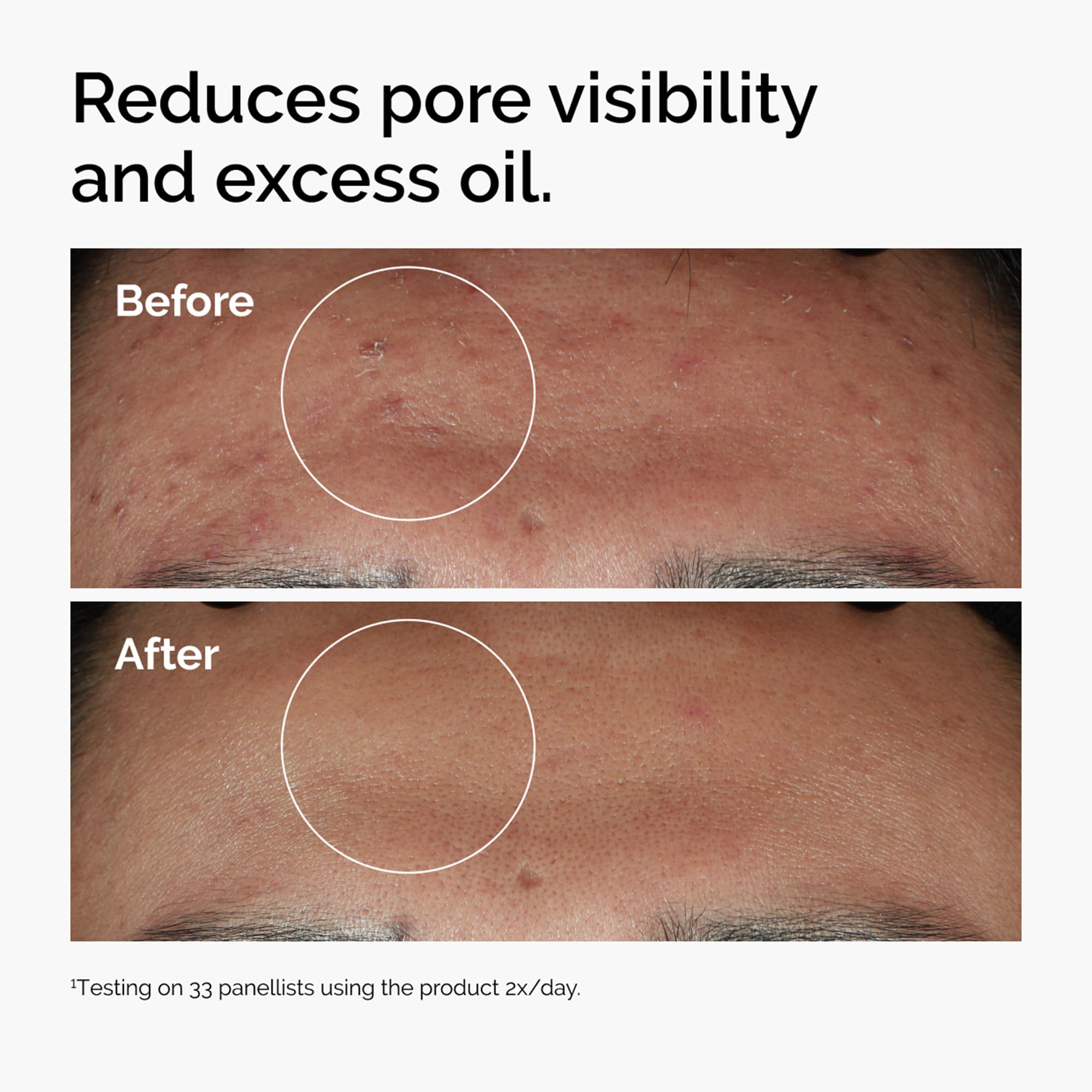 The Ordinary Niacinamide 10% + Zinc 1%, Brightening & Smoothing Serum for Blemish-Prone Skin, 60ml