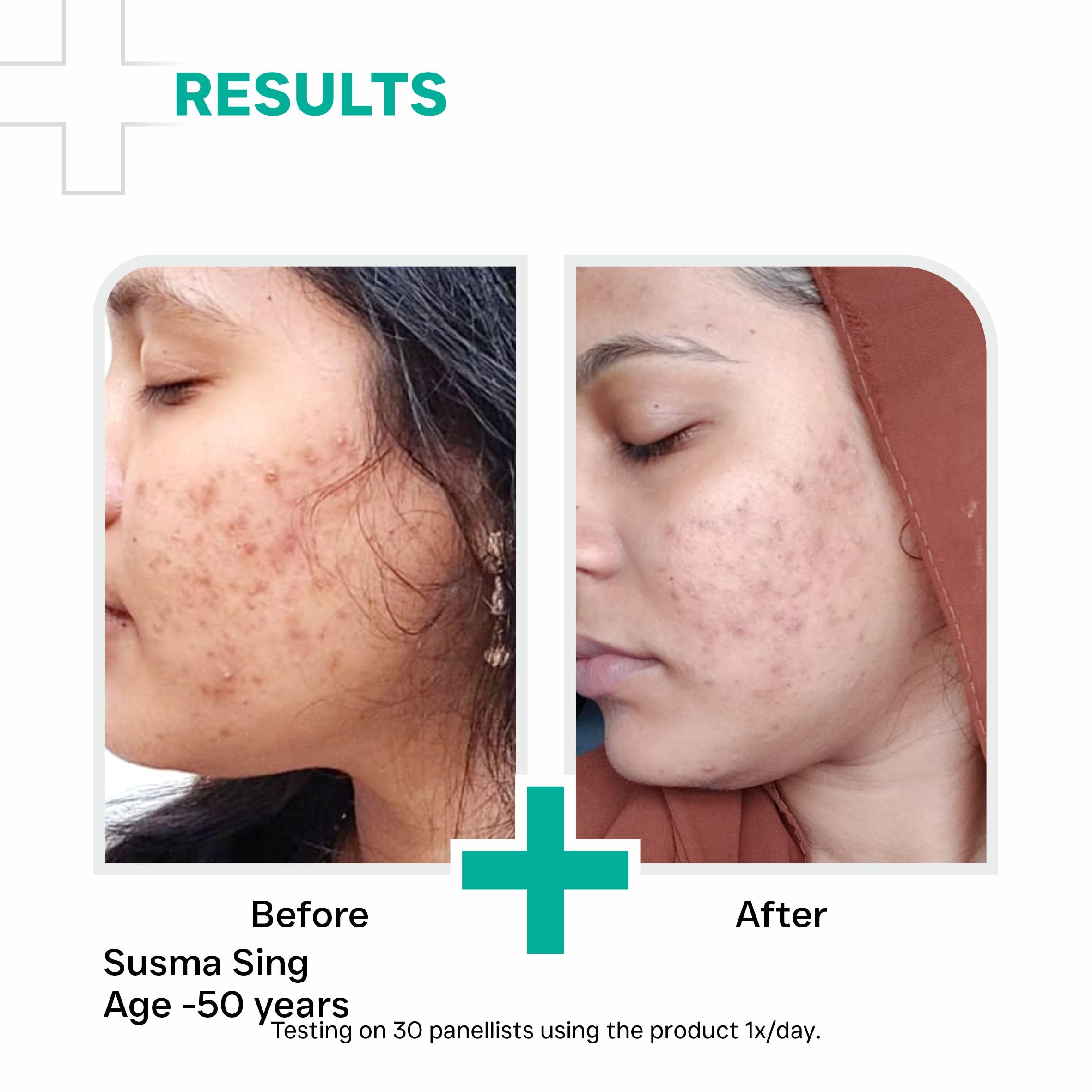 DERMATOUCH Salicylic Acid 2% Niacinamide 6% Anti-Acne Oil-Free Gel For Active Acne, Oil Balancing, Pore Tightening | 70g