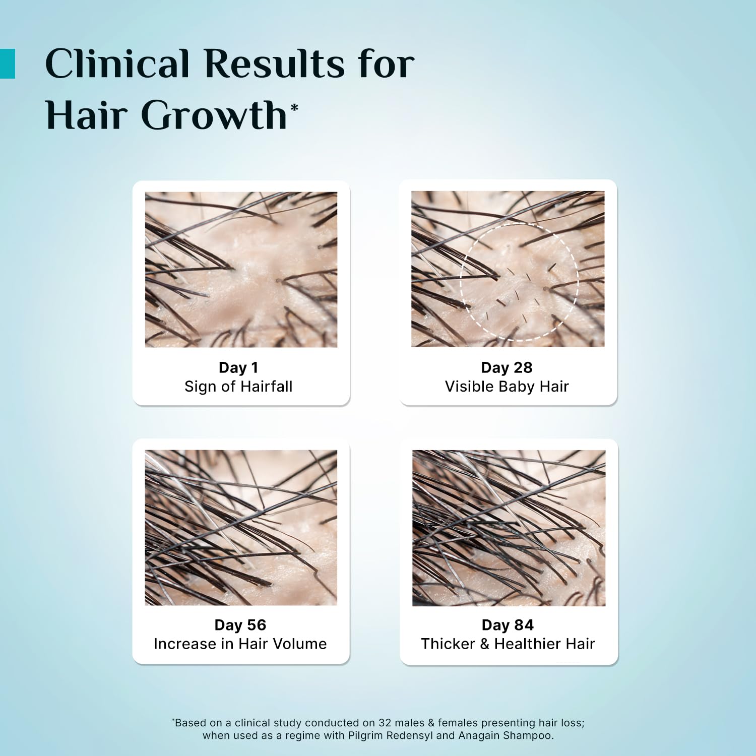 Pilgrim Redensyl 3% + Anagain 4% Advanced Hair Growth Serum (100ml) with Korean Black Rice, Controls Hair Fall, Stimulates Hair Growth, Increase Hair Density | HairGrowth Serum for Men & Women