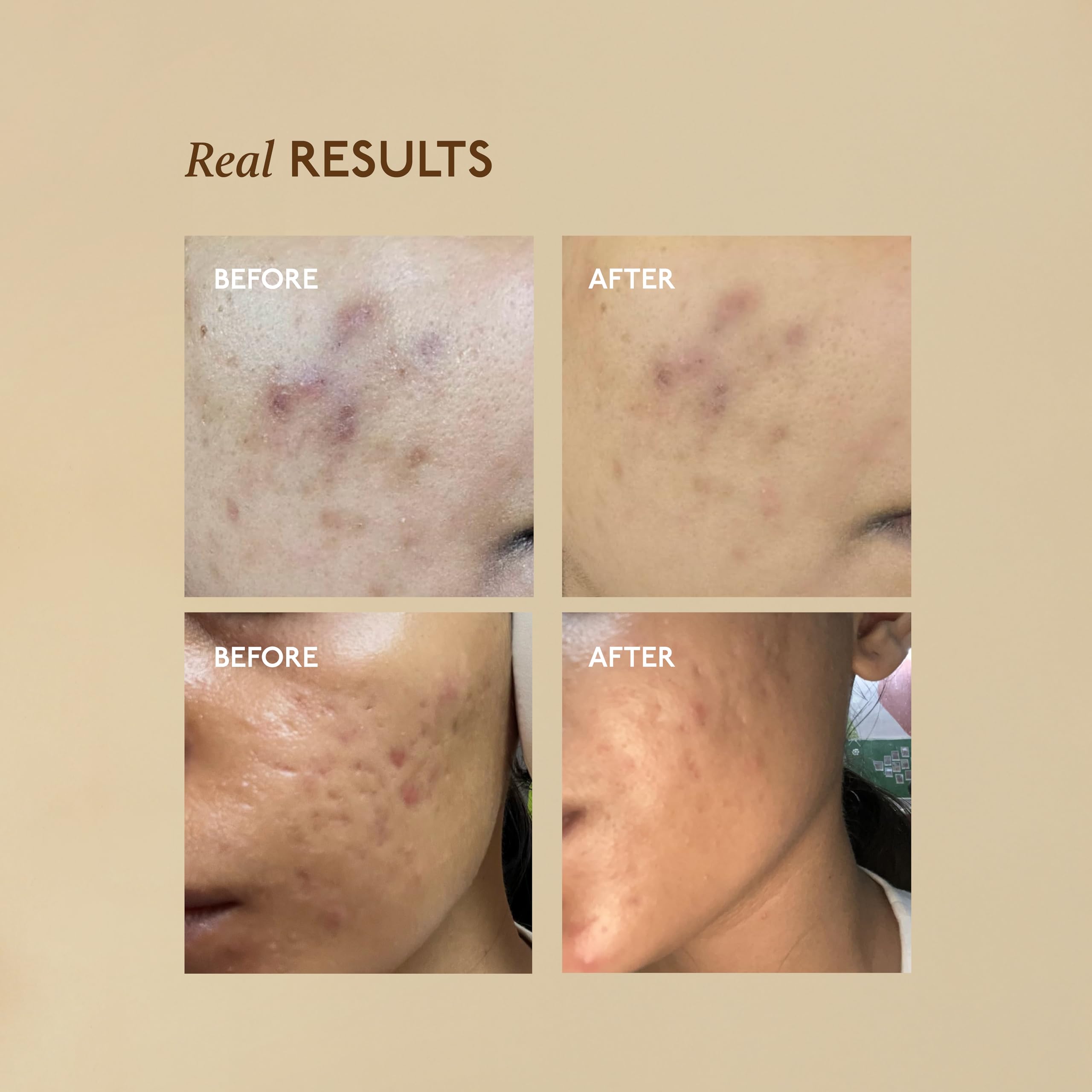 Asaya Advanced Spot Pigmentation Face Serum | Reduces Dark Spots, Melasma, Acne Marks & Hyperpigmentation | MelaMe™ Complex, Niacinamide & Alpha Arbutin | Evens Skin Tone & Brightens Dull Skin | 30ml