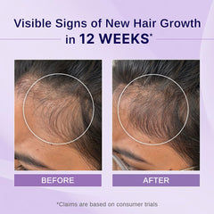 Bare Anatomy Nature x Science Rosemary Hibiscus Hair Growth Oil for Women & Men | Promotes New Hair Growth & Strengthens Hair | Nourishes Scalp & Controls Hair Fall | For All Hair Types-100ml