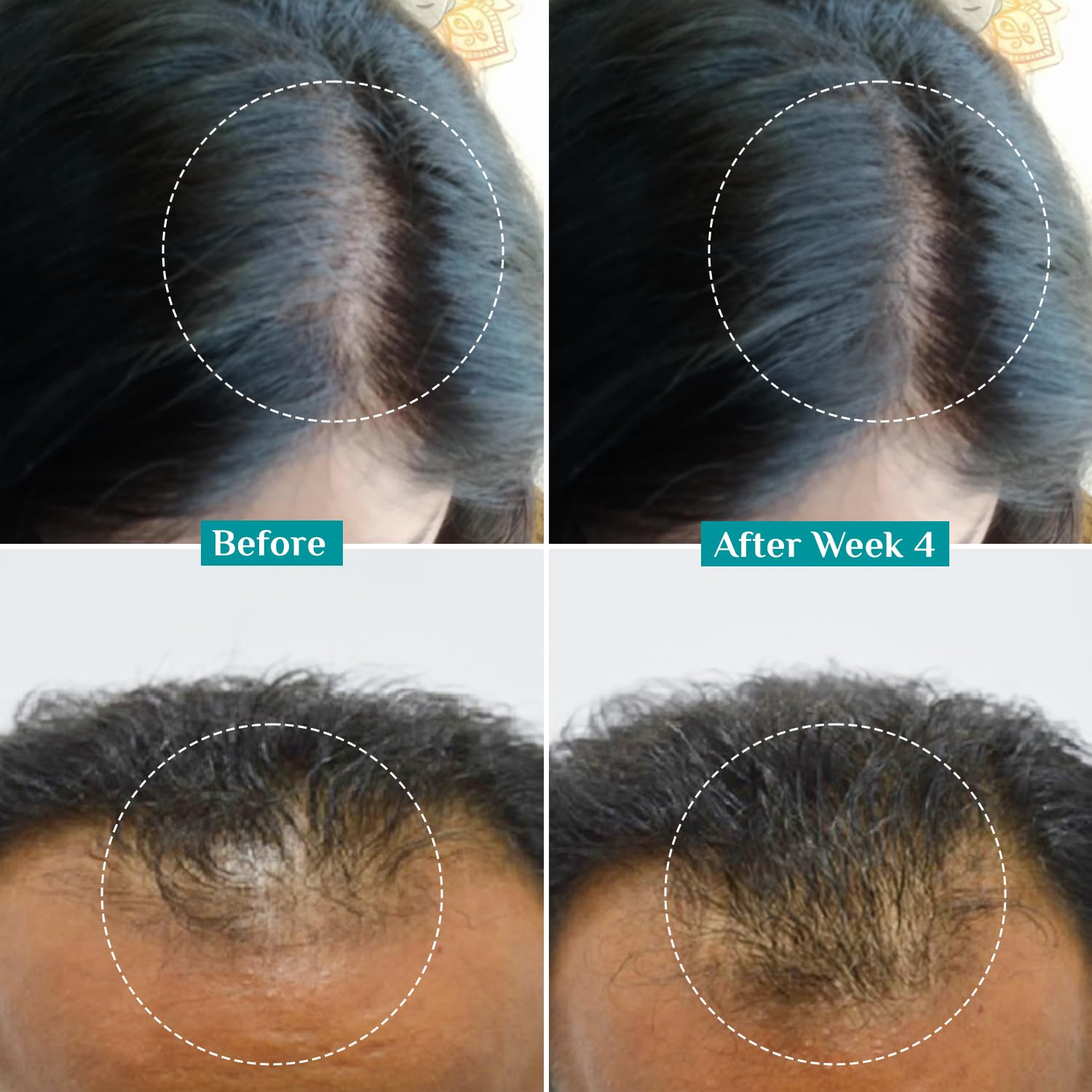 Pilgrim Redensyl 3% + Anagain 4% Advanced Hair Growth Serum (100ml) with Korean Black Rice, Controls Hair Fall, Stimulates Hair Growth, Increase Hair Density | HairGrowth Serum for Men & Women