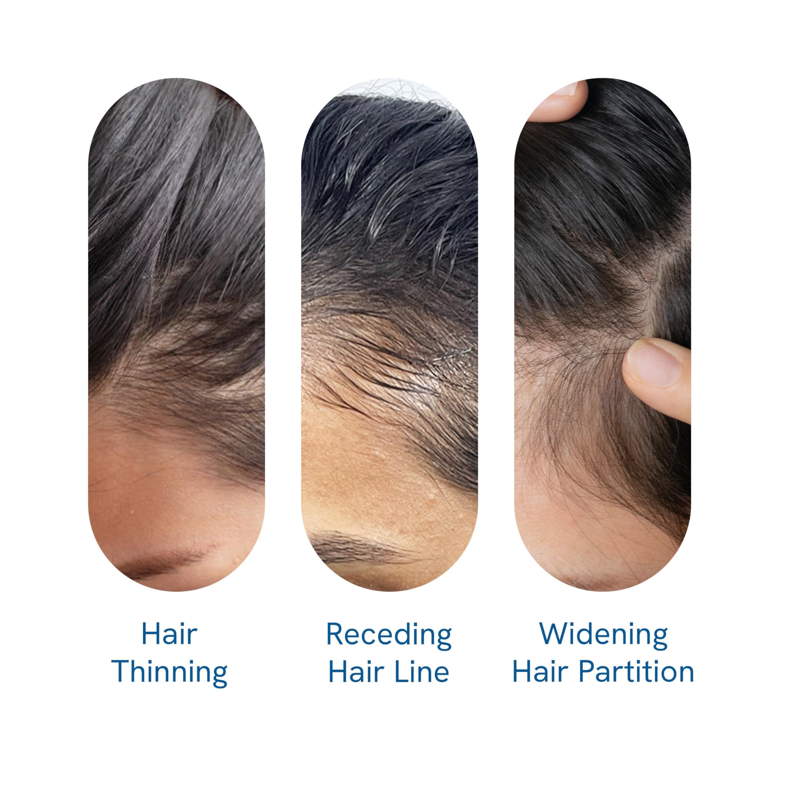 Be Bodywise Rosemary Hair Growth Serum (Roll On) | 3% Redensyl & 2% Anagain | Hair fall control serum for Women & Men | Promotes Hair Growth & Stimulates Hair Follicles | For All Hair Types | 25ml