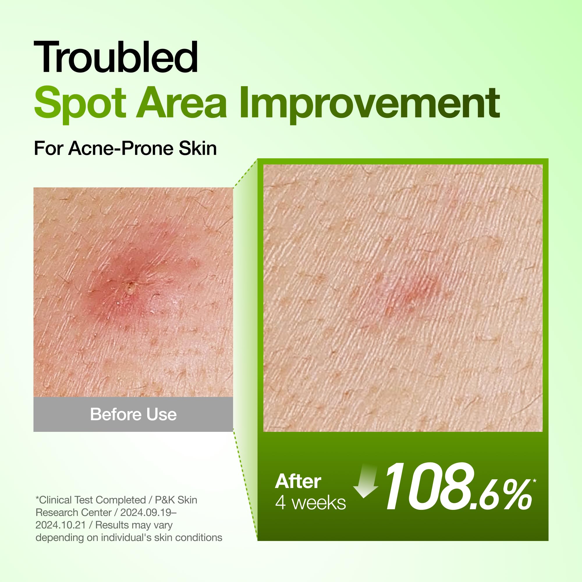 Anua Azelaic Acid 10 Hyaluron Redness Soothing Serum with Cica Soothes & Calms Acne-Prone Skin